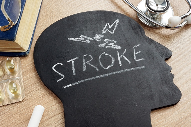 Stroke In Women Vs Stroke In Men Whats Different And Whats The Same
